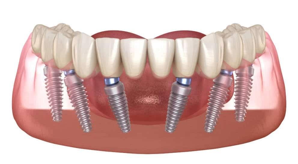 all on six clinica dental doctor charani