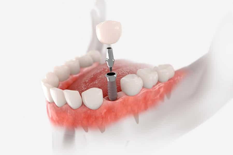 Implantes de carga inmediata Valencia