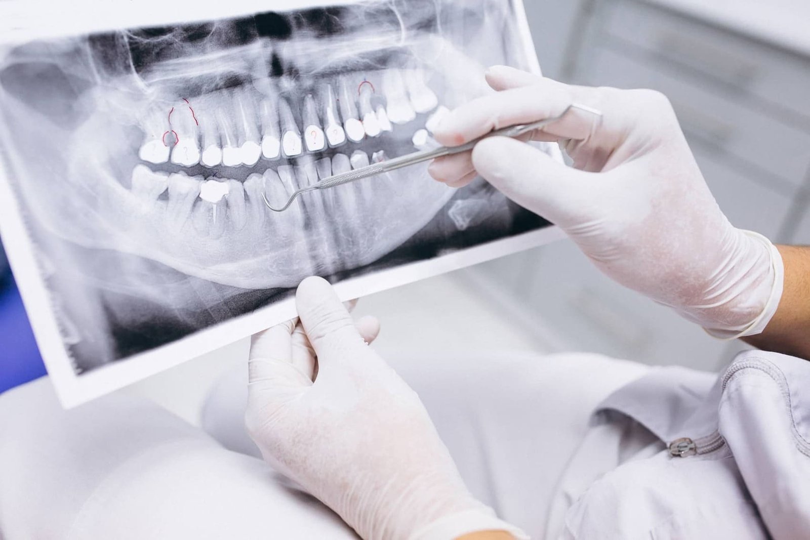 implantes cortos clinica dental doctor charani