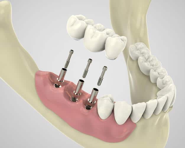 Implantes dentales Valencia