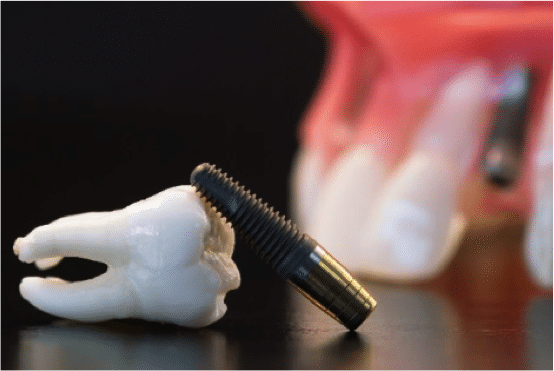 implantes post extraccion
