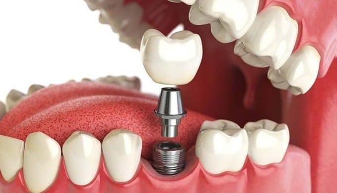 implantes sin cirugia
