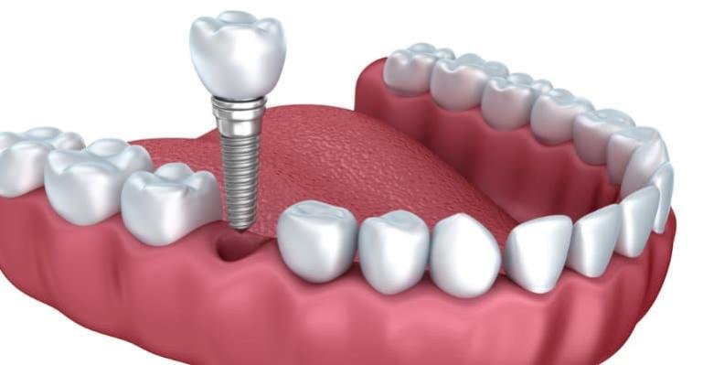 implantes sin cirugia charani